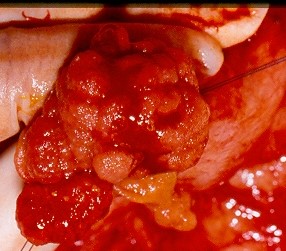 Αφαιρεθέντες πολύποδες, ενδοσκοπικά και χειρουργικά (Ευγενική παραχώρηση Dr. V. Penopoulos)