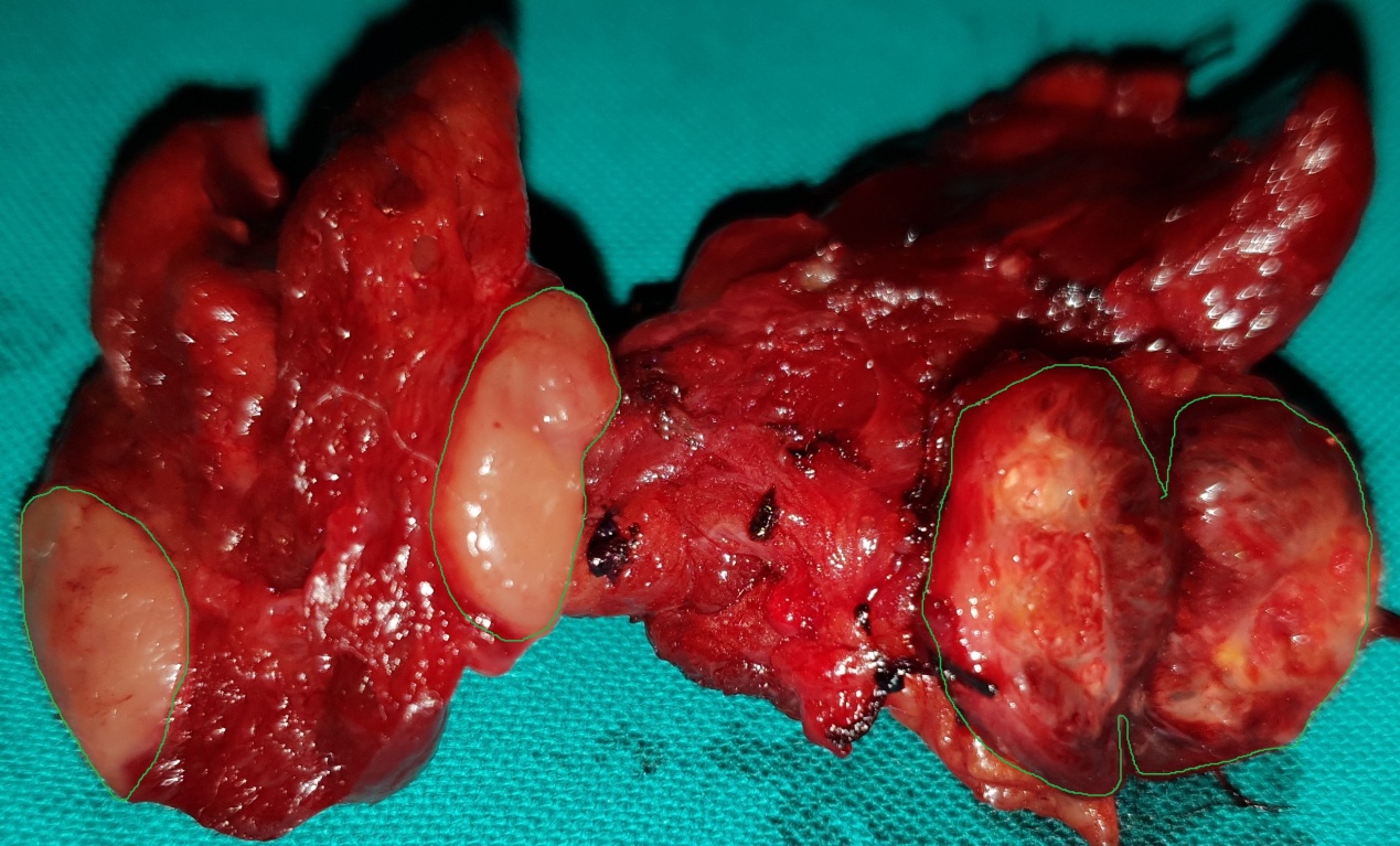 Water-clear cell parathyroid adenoma. The cells display minimal nuclear pleomorphism and have a uniform foamy cytoplasm (Courtesy Dr. V. Penopoulos)