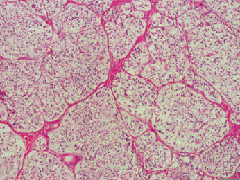 Water-clear cell parathyroid adenoma. The cells display minimal nuclear pleomorphism and have a uniform foamy cytoplasm (Courtesy Dr. V. Penopoulos)
