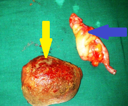 Μεγάλος κοπρόλιθος. Μίνι δεξιά ημικολεκτομή (Ευγενική παραχώρηση Dr. V. Penopoulos).