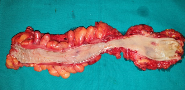 Colposcopy. Red arrow. Evident erosion and protrusion of the mesh from the vaginal vault (Courtesy Dr. V. Penopoulos)