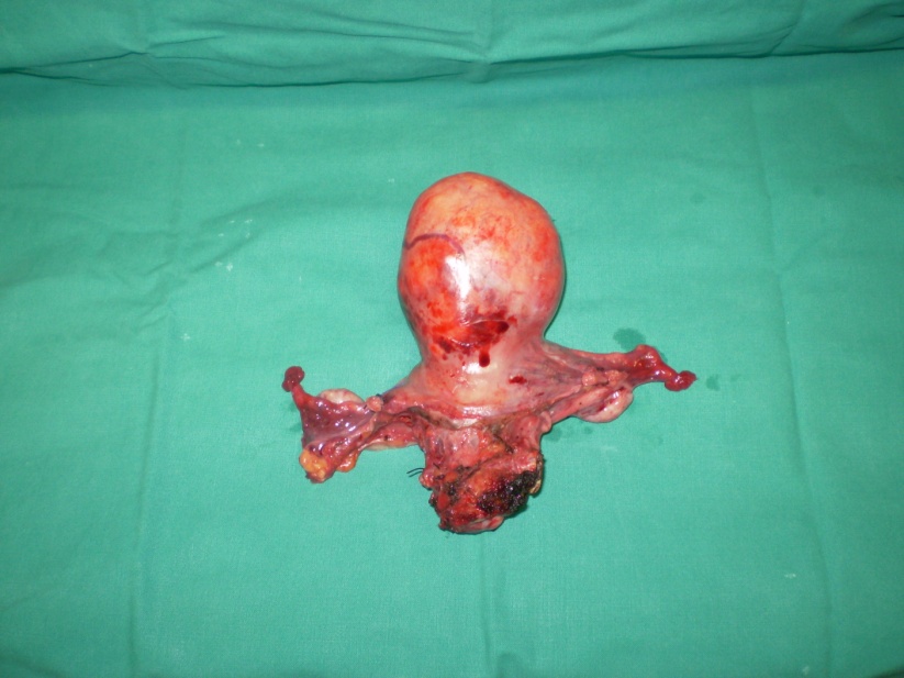 Colposcopy. Red arrow. Evident erosion and protrusion of the mesh from the vaginal vault (Courtesy Dr. V. Penopoulos)