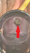 Colposcopy. Red arrow. Evident erosion and protrusion of the mesh from the vaginal vault (Courtesy Dr. V. Penopoulos)