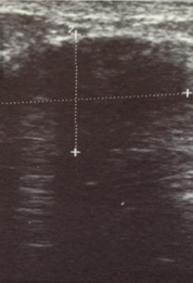 Υπερηχογράφημα αριστερού μαστού (Ευγενική παραχώρηση Dr. V. Penopoulos)