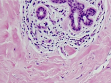 Έντονη ινώδης μεταβολή στρώματος και λεμφοκυτταρική διήθηση γύρω από τους πόρους του μαστικού αδένα (Ευγενική παραχώρηση Dr. V. Penopoulos)