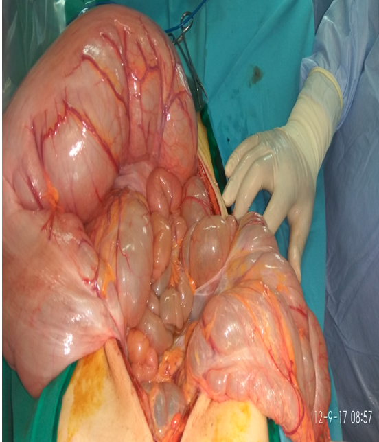 Καθολική γιγαντιαία διάταση ολόκληρου του κόλου (Ευγενική παραχώρηση Dr. V. Penopoulos)