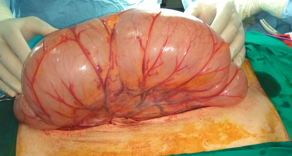 Γιγαντιαία διάταση του δεξιού κόλου (Ευγενική παραχώρηση Dr. V. Penopoulos)