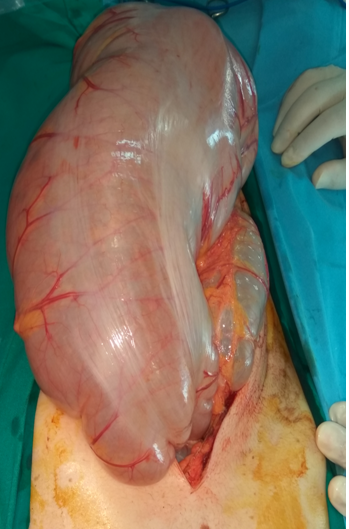 Παρασκεύασμα υπολικής κολεκτομής (Ευγενική παραχώρηση Dr. V. Penopoulos)