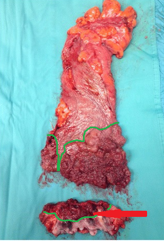 Παρασκεύασμα κοιλιοπερινεϊκής εκτομής ορθού. Διακρίνεται σχεδόν πλήρης κατάληψη του αυλού του ορθού, εκτεινόμενη έως την ορθοπρωκτική συμβολή, με συνοδό διήθηση των σφιγκτήρων (Ευγενική παραχώρηση Dr. V. Penopoulos)