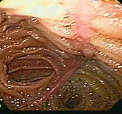 Normal jejunojejunal anastomosis (lower Roux anastomosis) (Courtesy Dr. V. Penopoulos).