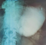 Barium retention in the distended gastric remnant (Courtesy Dr. V. Penopoulos).