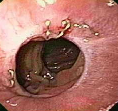 Esophagojejunal anastomosis - endoscopic image on the 30th postoperative day (Courtesy Dr. V. Penopoulos).