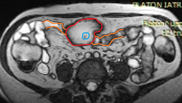 Lateral view. Red arrows: gastrocolic fistula (Courtesy Dr. V. Penopoulos)
