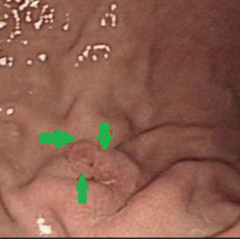 Dissection – Demonstration of the fistulous tract (Courtesy Dr. V. Penopoulos)