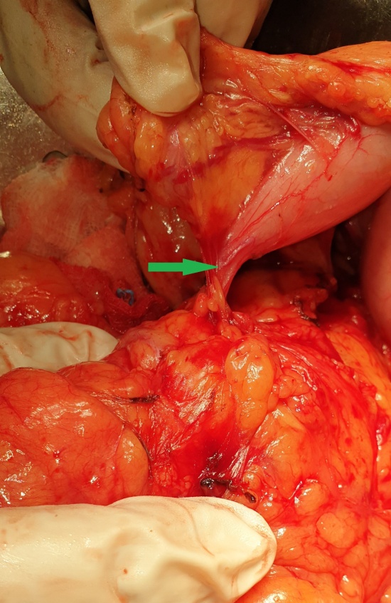 Dissection – Demonstration of the fistulous tract (Courtesy Dr. V. Penopoulos)