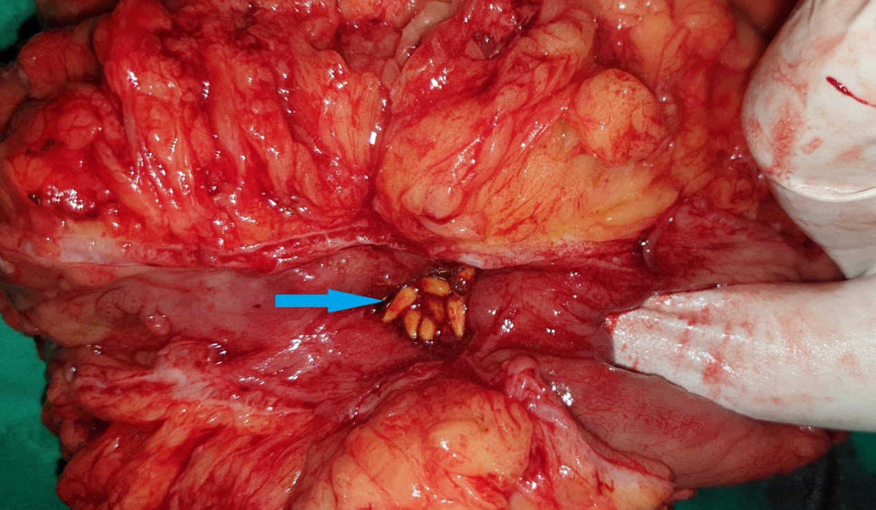 Dissection – Demonstration of the fistulous tract (Courtesy Dr. V. Penopoulos)