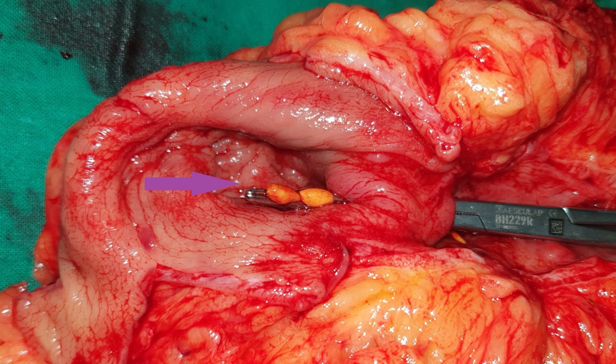Dissection – Demonstration of the fistulous tract (Courtesy Dr. V. Penopoulos)