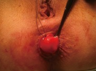 Διαπρωκτική εκτομή της βλάβης (Ευγενική παραχώρηση Dr. V. Penopoulos)