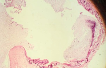 Κύστη που περιέχει πυκνή βλέννα, επενδυμένη με καλόηθες κολικό επιθήλιο, περιβαλλόμενη από ίνωση (Ευγενική παραχώρηση Dr. V. Penopoulos)