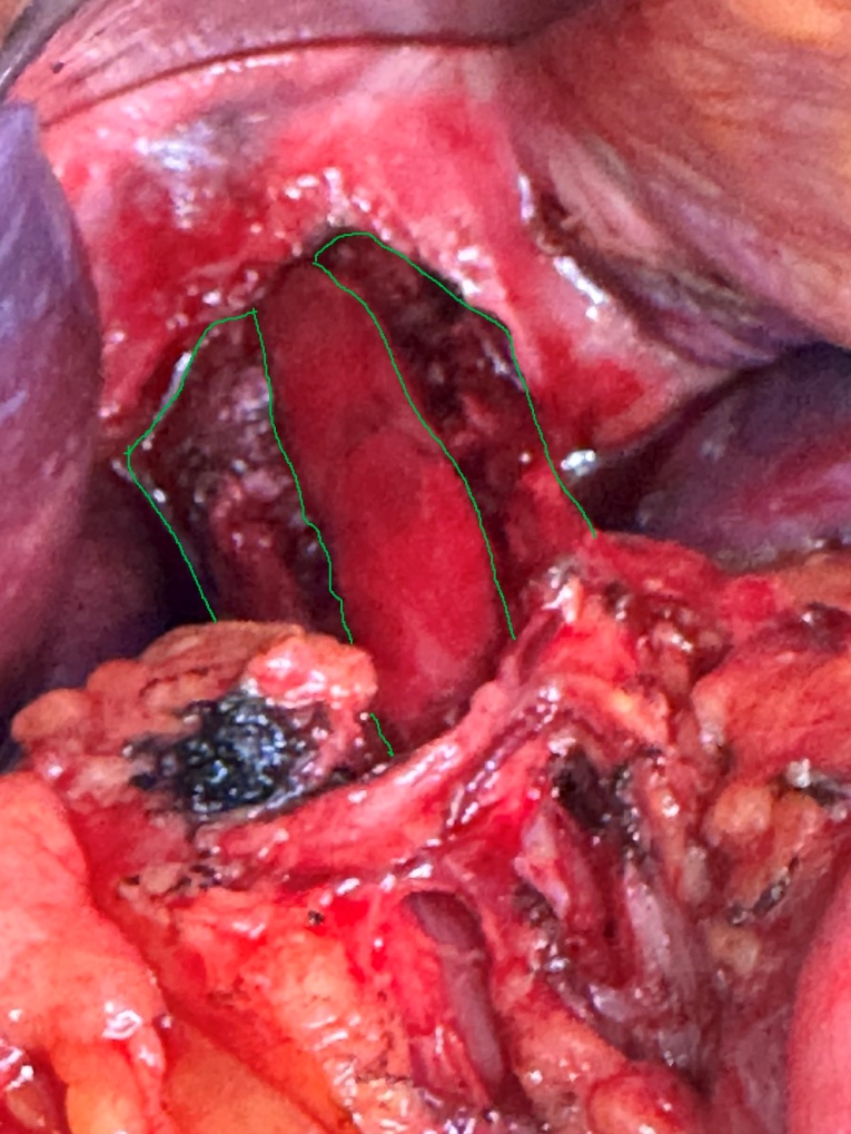 Postoperative image of long myotomy. Green outline — the divided muscular layers of the esophagus. The esophageal mucosa is exposed at the center. The myotomy extends onto the stomach (Courtesy Dr. V. Penopoulos)