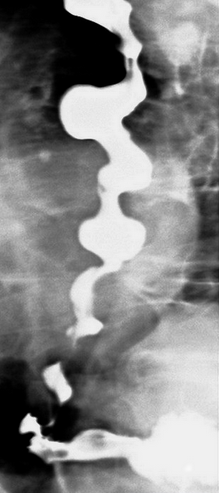 Diffuse esophageal spasm (Courtesy Dr. V. Penopoulos)