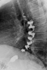 Nutcracker (corkscrew) esophagus (Courtesy Dr. V. Penopoulos)