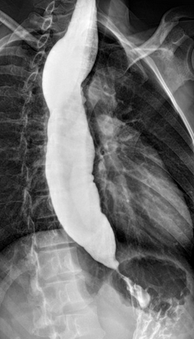 Scleroderma esophagus (Courtesy Dr. V. Penopoulos)