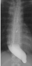 Straight type of esophageal achalasia (Courtesy Dr. V. Penopoulos)