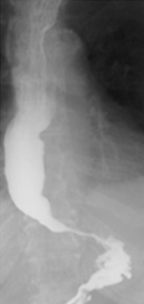 Sigmoid type of esophageal achalasia (Courtesy Dr. V. Penopoulos)