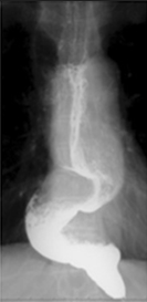 Advanced sigmoid type (Courtesy Dr. V. Penopoulos)