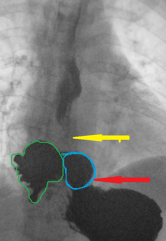 Barium swallow. Red arrow — previous Nissen fundoplication. Yellow arrow — narrowed distal esophagus with tapering of its terminal segment. Green outline — right paraesophageal hiatal hernia (Courtesy Dr. V. Penopoulos)