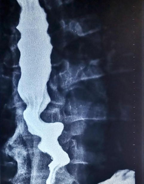 Tertiary contractions (Courtesy Dr. V. Penopoulos)