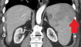 Splenic rupture — posterolateral surface (Courtesy Dr. V. Penopoulos)