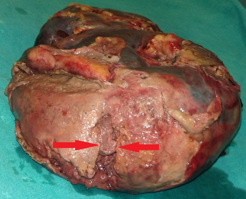 Splenic rupture — posterolateral surface (Courtesy Dr. V. Penopoulos)