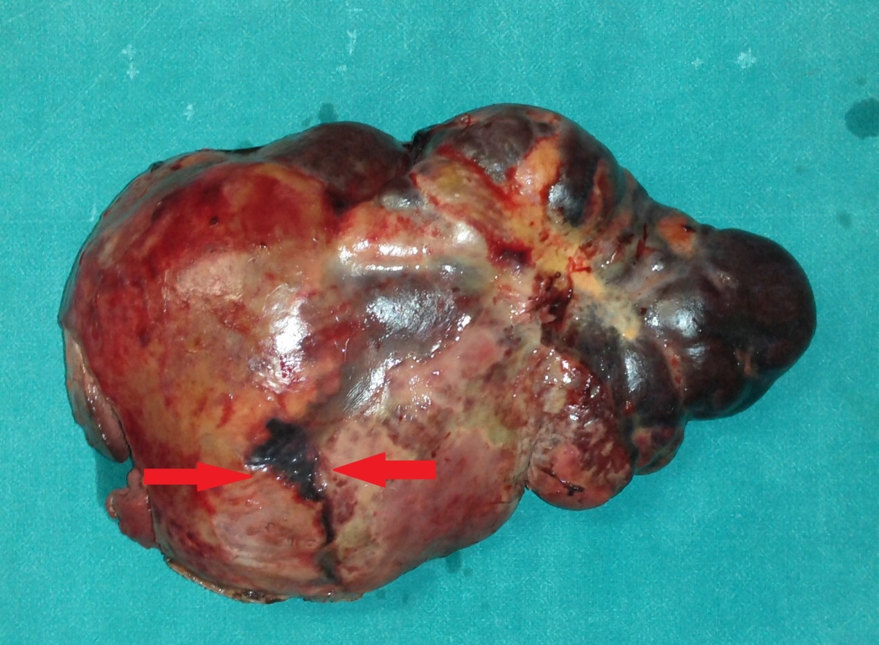 Splenic rupture — posterolateral surface (Courtesy Dr. V. Penopoulos)