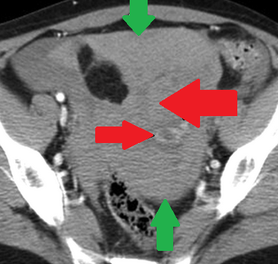 Ρήξη έκτοπης κύησης — αιμοπεριτόναιο (Ευγενική παραχώρηση Dr. V. Penopoulos)