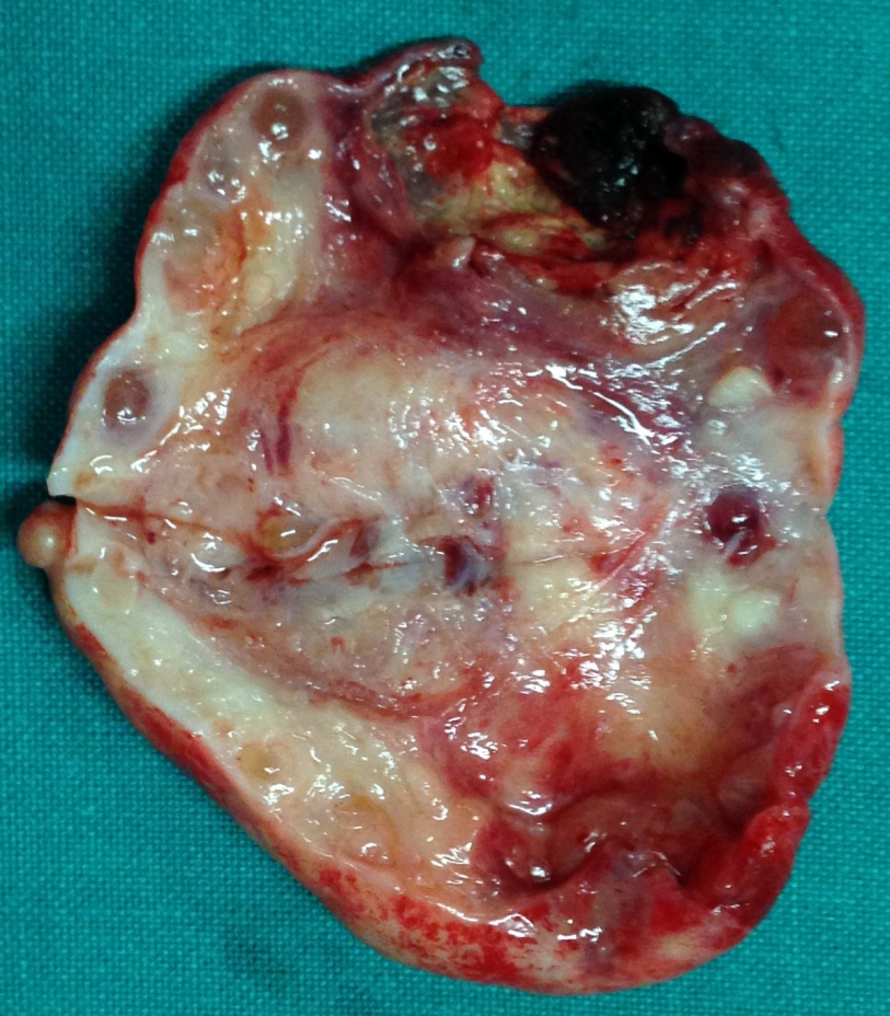 Έκτοπη κύηση (Ευγενική παραχώρηση Dr. V. Penopoulos)