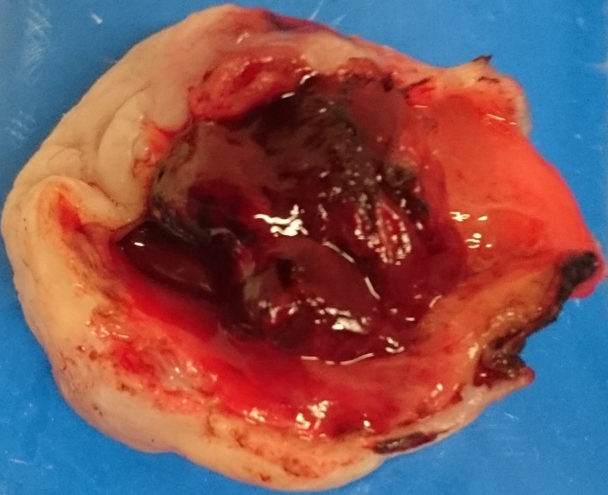 Αιμορραγική ωοθηκική κύστη (Ευγενική παραχώρηση Dr. V. Penopoulos)