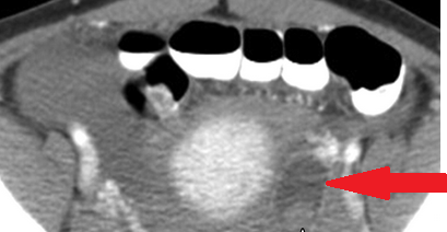 Ρήξη ωχρού σωματίου — αιμοπεριτόναιο (Ευγενική παραχώρηση Dr. V. Penopoulos)