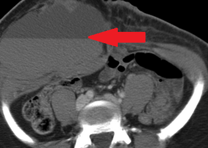 Αιμάτωμα ορθού κοιλιακού μυός — αντιπηκτική αγωγή (Ευγενική παραχώρηση Dr. V. Penopoulos)
