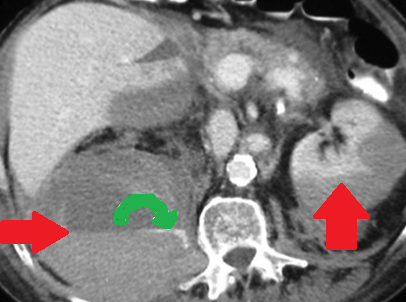 Αριστερό περινεφρικό αιμάτωμα και δεξιό αιμάτωμα λαγονοψοΐτη — αντιπηκτική αγωγή (Ευγενική παραχώρηση Dr. V. Penopoulos)