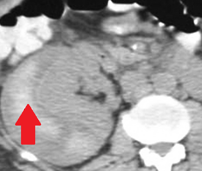 Περινεφρικά αιματώματα — αντιπηκτική αγωγή (Ευγενική παραχώρηση Dr. V. Penopoulos)