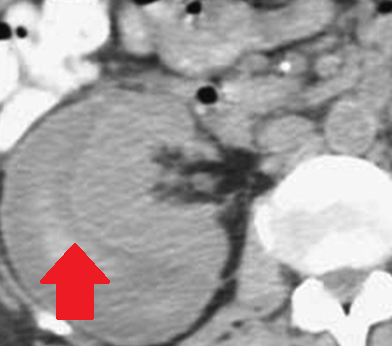 Περινεφρικά αιματώματα — αντιπηκτική αγωγή (Ευγενική παραχώρηση Dr. V. Penopoulos)