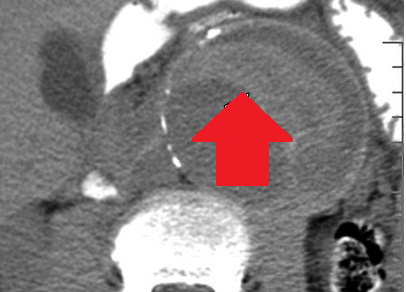 Ρήξη ανευρύσματος κοιλιακής αορτής (Ευγενική παραχώρηση Dr. V. Penopoulos)