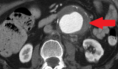 Ρήξη ανευρύσματος κοιλιακής αορτής (Ευγενική παραχώρηση Dr. V. Penopoulos)