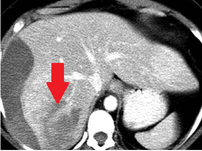 Αυτόματη ρήξη ηπατοκυτταρικών καρκινωμάτων (Ευγενική παραχώρηση Dr. V. Penopoulos)
