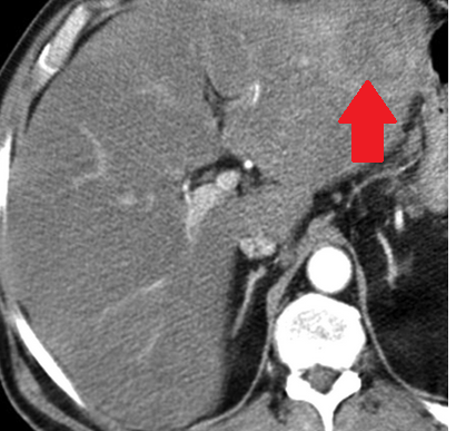 Αυτόματη ρήξη σπληνός (Ευγενική παραχώρηση Dr. V. Penopoulos)