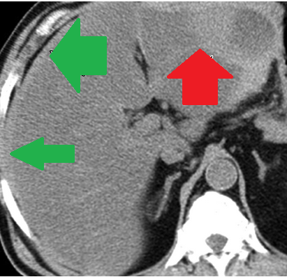 Αυτόματη ρήξη/αιμορραγία νεφρού — αγγειομυολίπωμα (Ευγενική παραχώρηση Dr. V. Penopoulos)