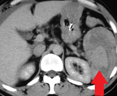 Αυτόματη ρήξη/αιμορραγία νεφρού — νεφροκυτταρικό καρκίνωμα (Ευγενική παραχώρηση Dr. V. Penopoulos)