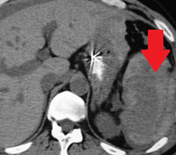 Αμφοτερόπλευρη αυτόματη νεφρική αιμορραγία — κοκκιωμάτωση Wegener (Ευγενική παραχώρηση Dr. V. Penopoulos)